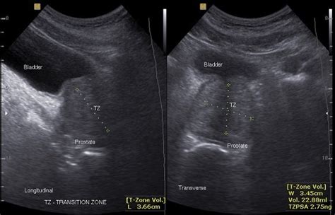 Transabdominal Ultrasound Of The Prostate Showing Measurement Of The Download Scientific