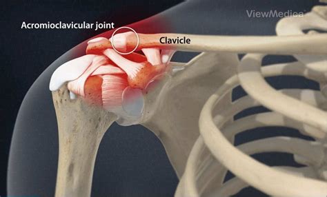 Acromioclavicular Joint Ac Joint In Shoulder Ac Joint Pain