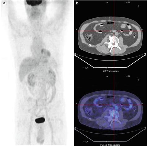 Castlemans Disease Radiology Key