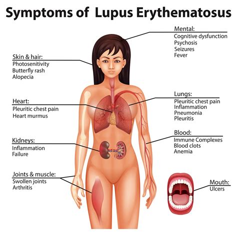 Lupus Everything You Need To Know Autoimmune Diseases Medical