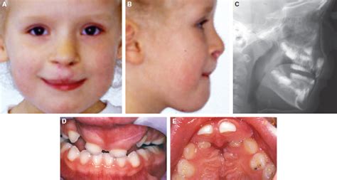 Orthodontic Principles In The Management Of Orofacial Clefts Pocket