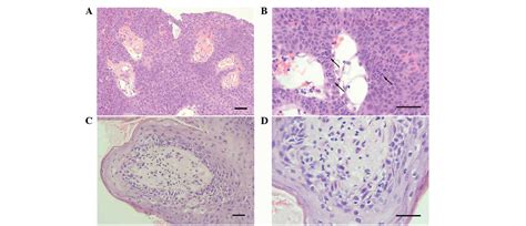 Middle Ear Squamous Papilloma A Report Of Four Cases Analyzed By HPV