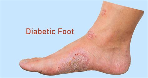 Diabetic Foot Treatment In Hyderabad Expert Advice And Effective Solutions