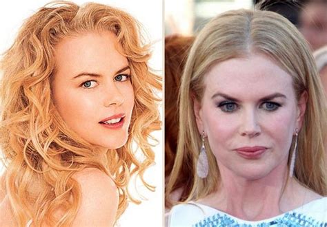 Nicole Kidman Plastic Surgery For Puffy Look Facial Fillers Botox