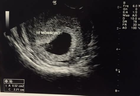 6 Week Ultrasound Babycenter