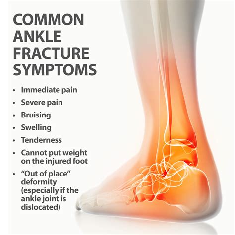 Ankle Fracture Guide Causes Symptoms And Treatment Options My XXX Hot