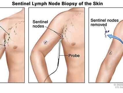 Breast cancer is a disease in which malignant cells form in the tissues of the breast. Cancer In Lymph Nodes Under Arm - Cancer News Update