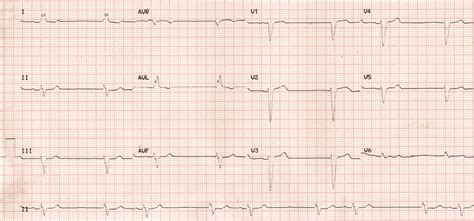 Ecg Quiz 61 All About Cardiovascular System And Disorders