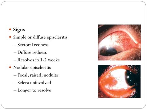 Ppt Episcleritis And Scleritis Powerpoint Presentation Free Download