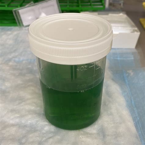 Urine Sediment Of The Month Urines True Colors Renal Fellow Network