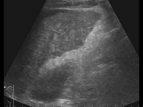 Abdomen And Retroperitoneum 11 Liver Case 1112 Cirrhosis And