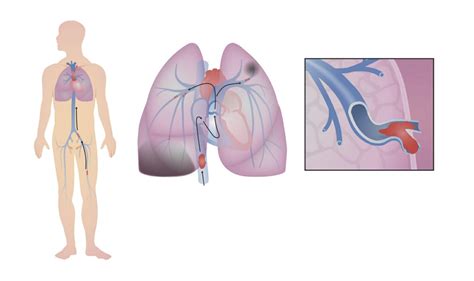 Tromboembolismo Pulmonar Concise Medical Knowledge