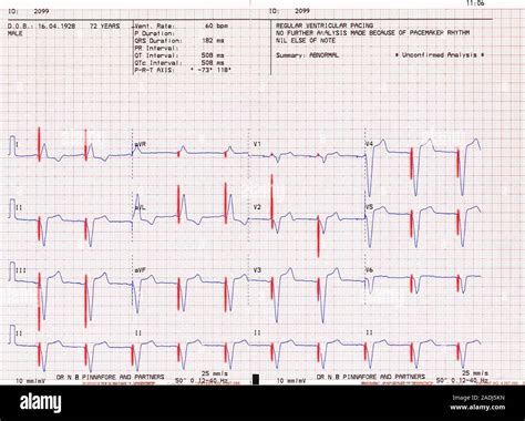 Marcapasos Cardíaco Electrocardiograma Ecg Muestra El Latido Del