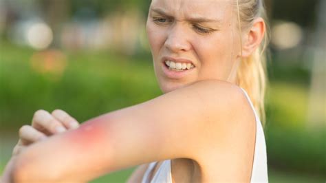 How To Tell The Difference Between Mrsa And A Spider Bite