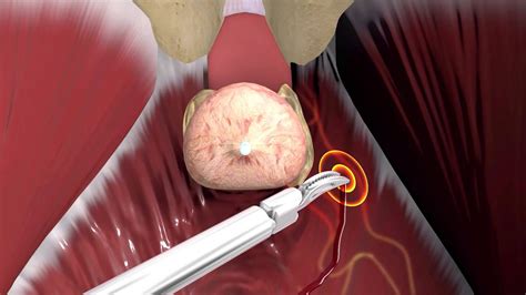 What You Need To Know Prior To Prostate Surgery Youtube