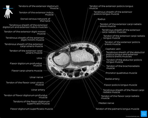Axial MRI Of Upper Limb Tendon Of The Extensor Carpi Radialis Brevis