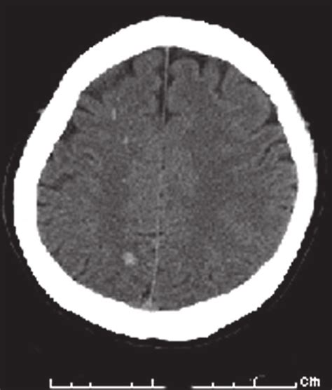 The Head Ct Scan Shows Multiple Petechial Cerebral Bleeding Download