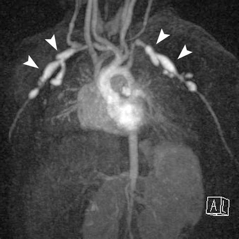 Spectrum Of Coronary Artery Aneurysms From The Radiologic Pathology