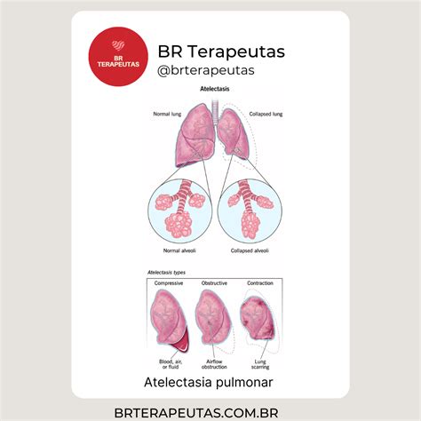 Atelectasia Pulmonar O Que é