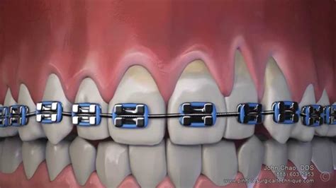 Gum Recession After Wearing Braces Can Now Be Treated Without Gum Grafting Surgery Youtube