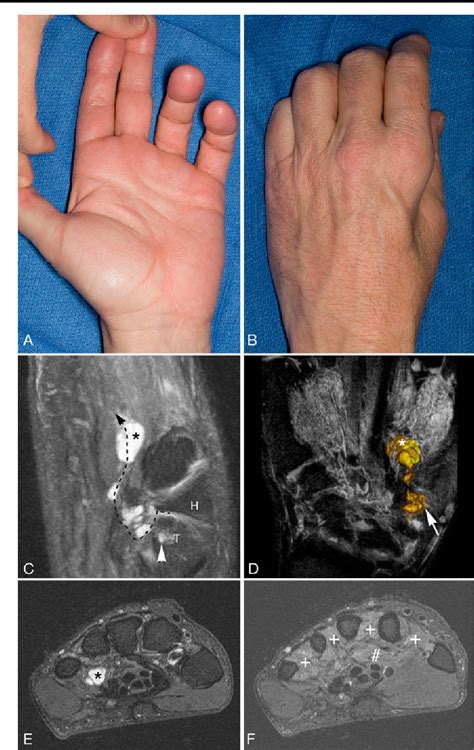 Figure From An Intraneural Ganglion Cyst Of The Ulnar Nerve At The