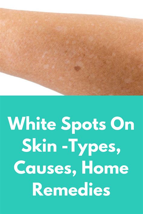 White Spots On Skin What Causes White Spots On Skin