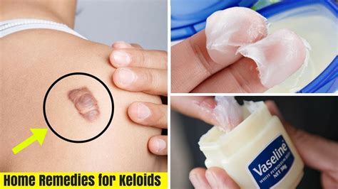 I had a keloid scar on the back of my ear that developed when i attempted to remove a mole some years ago. 3 Effective remedies to remove keloid scars naturally ...