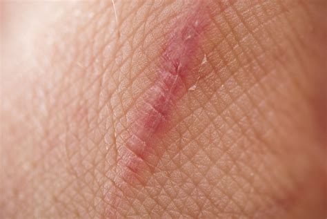 Types Of Scar Tissue And How To Prevent Them Facty Health