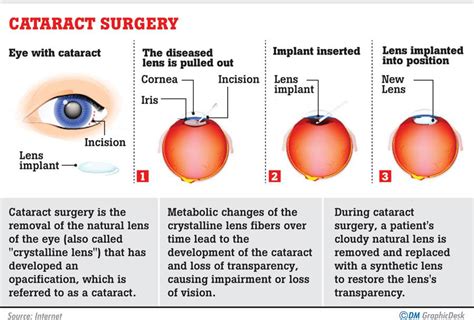 Cataract Dont Let Misconception Blind You Medicine Daily Mirror