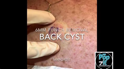 Drainage And Punch Removal Of Cyst Cyst Pop Big Squeeze Punch