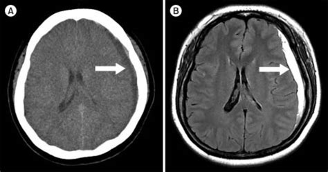 Int j obstet anesth 2017; Definición de Hematoma Subdural » Concepto en Definición ABC