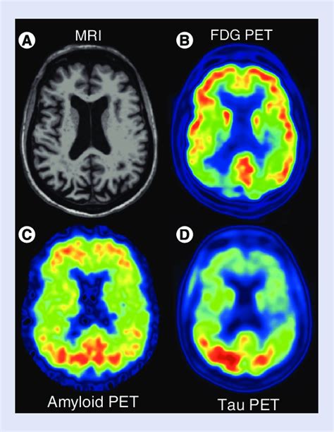 This Posterior Cortical Atrophy Patient Presented With Prosopagnosia Download Scientific