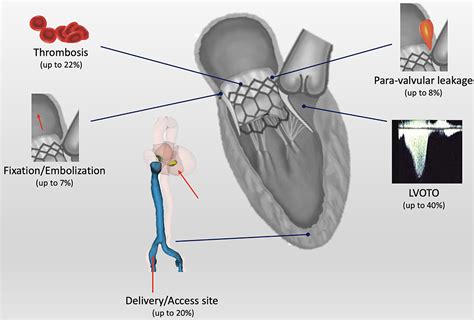 Frontiers Challenges And Open Issues In Transcatheter Mitral Valve