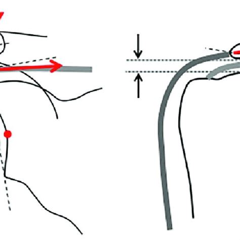 The arthroscopic classification of acromial spur morphology has several implications, which are not only to improve the communication between the. a) Bigliani et al 5 classified the acromion into three ...
