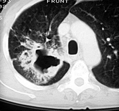They grow along with, and at the same rate as, the organ from whose tissue they are made, and, unlike cancerous tumors. Sammlung Radiologie der Lungentumoren