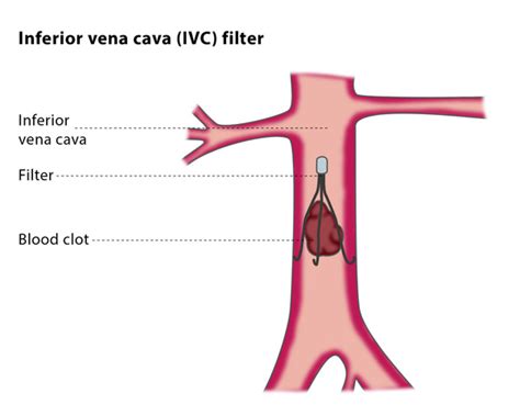 Inferior Vena Cavaivc Filter Placement Benefits And Risks How To Relief