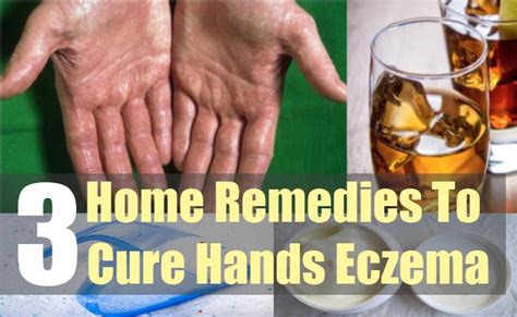 Hand Eczema Home Remedies Dorothee Padraig South West Skin Health Care