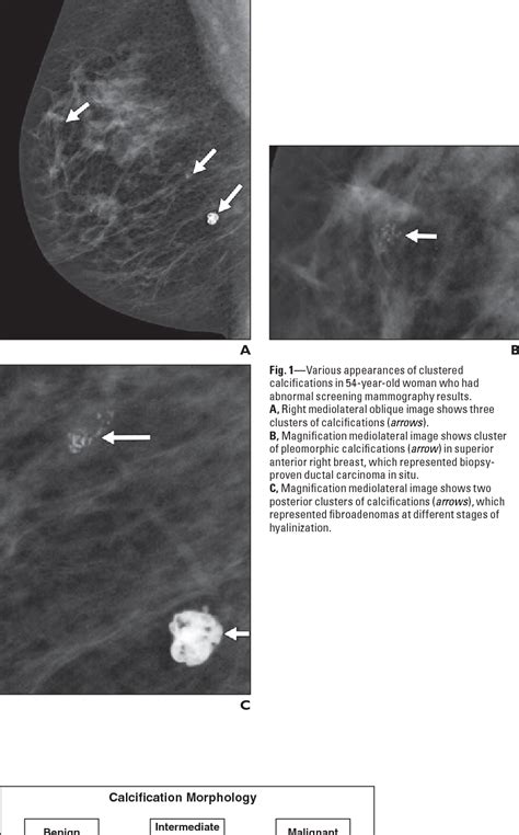 Figure From Breast Calcifications The Focal Group Semantic Scholar