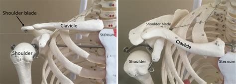 Clavicle Fracture Broken Collarbone Orthopaedic Trauma Association