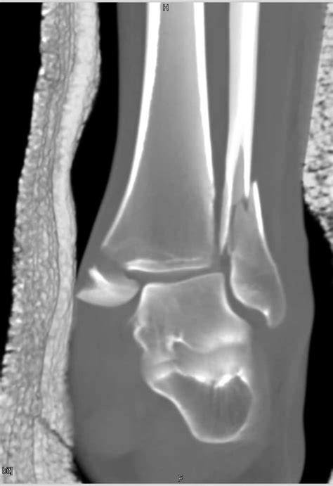 Fracture Of Distal Tibia And Fibula With Widening Of Ankle Mortise
