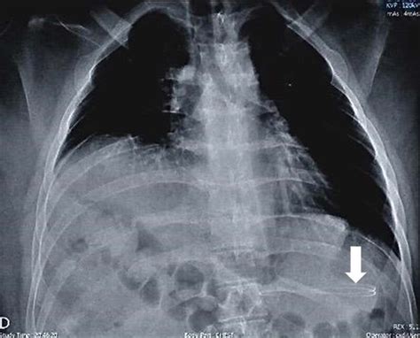 Chest X Ray Showing A Ventriculoperitoneal VP Shunt Catheter In The