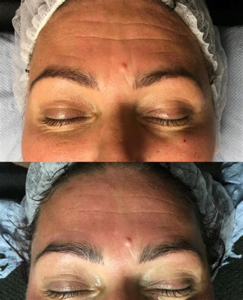 Excellent Results With Skinbase Md From One Of Our Therapists Jeanette