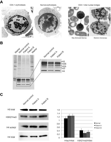 Chromatin Structure And Composition In Cda 1 Patients A Electron