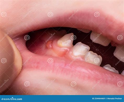 A Bump Is A Tumor On The Tooth Gum In A Child Periodontitis In