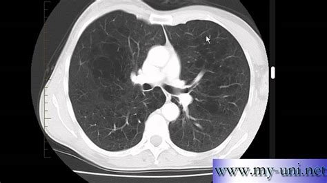 Emphysema On Ct Scan Of Chest Youtube