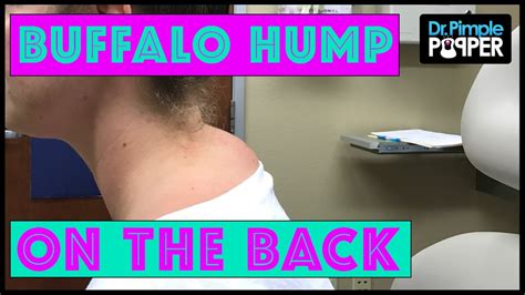 Not A True Buffalo Hump Lipoma With Dr Pimple Popper Youtube