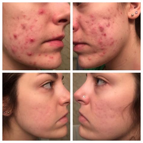 Before And After Accutane 6 Months Acne