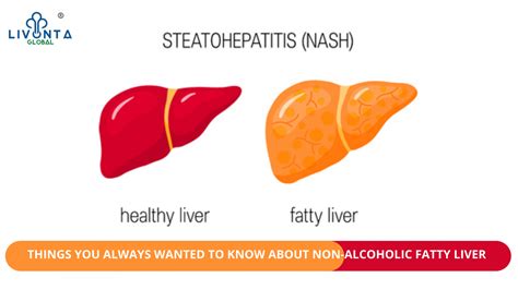 Things You Always Wanted To Know About Non Alcoholic Fatty Liver