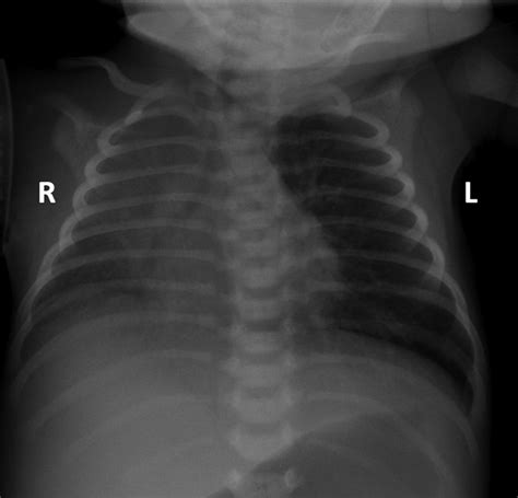 Chest X Ray Posterior Anterior Orientation From Initial Evaluation