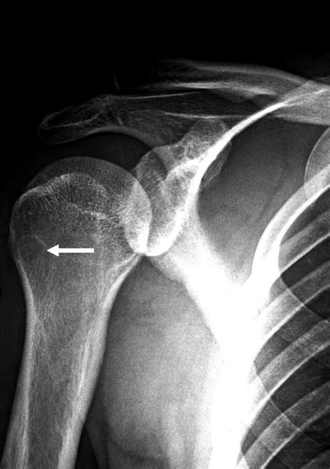 Osteoid Osteoma Of The Proximal Humerus A Misleading Case Journal Of